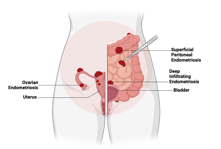 diagram of endometriosis