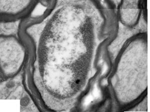 EctopicMyelination1
