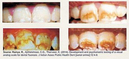 DENTAL FLUOROSIS