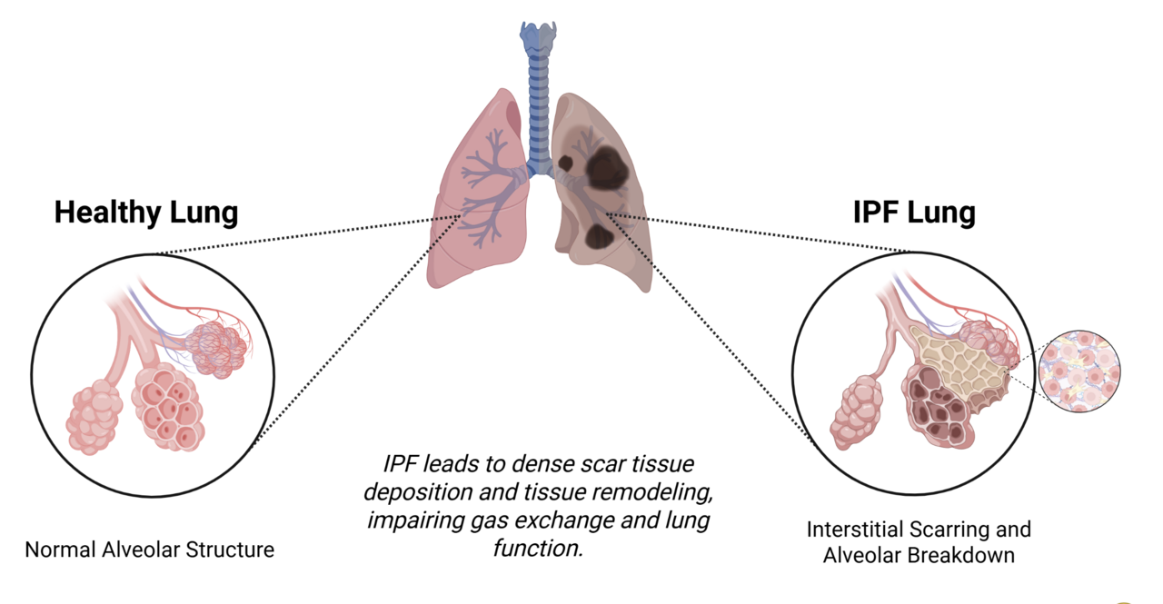 lung fibrosis