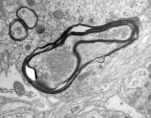 AD myelin damage